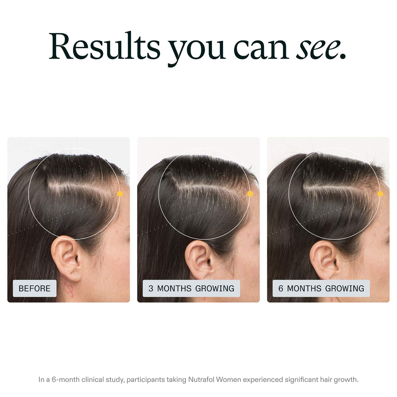 NUTRAFOL WOMEN Clinically Proven Hair Growth Supplement for Thinning preventa